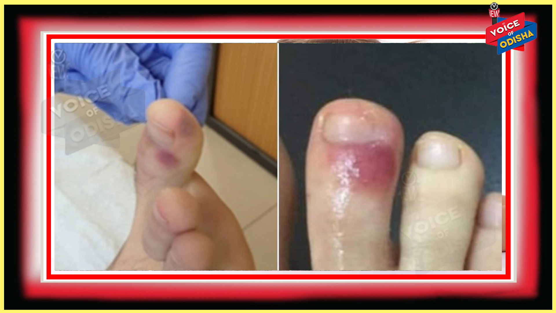 କଣ ପାଦରେ ଏପରି କ୍ଷତ କରୋନାର ସଙ୍କେତ? ଜାଣନ୍ତୁ କଣ କୁହନ୍ତି ଡାକ୍ତର