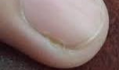 କୋଲେଷ୍ଟେରୋଲ୍ ବୃଦ୍ଧିର ସଙ୍କେତ ଦିଏ ନଖ