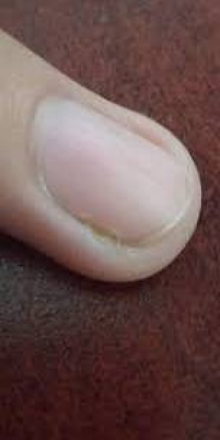 କୋଲେଷ୍ଟେରୋଲ୍ ବୃଦ୍ଧିର ସଙ୍କେତ ଦିଏ ନଖ